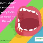 Mouth Ulcer Treatment Everything you need to know