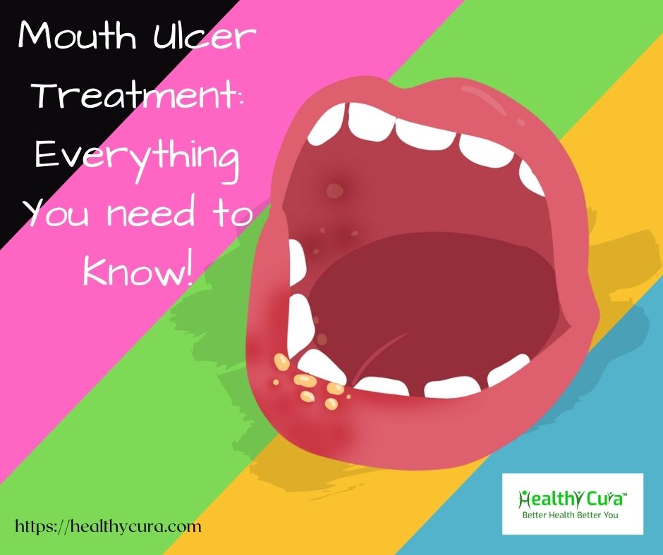 Everything About Mouth Ulcer Treatment (2022)