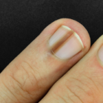 Do You Need to See a Doctor for a Black Line on the Nail