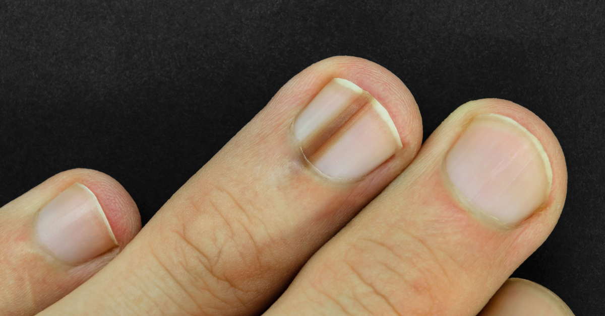 Do You Need to See a Doctor for a Black Line on the Nail