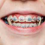 Understanding the Benefits of Using Rubber Bands with Braces