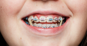 Understanding the Benefits of Using Rubber Bands with Braces