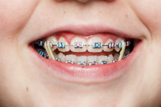 Understanding the Benefits of Using Rubber Bands with Braces