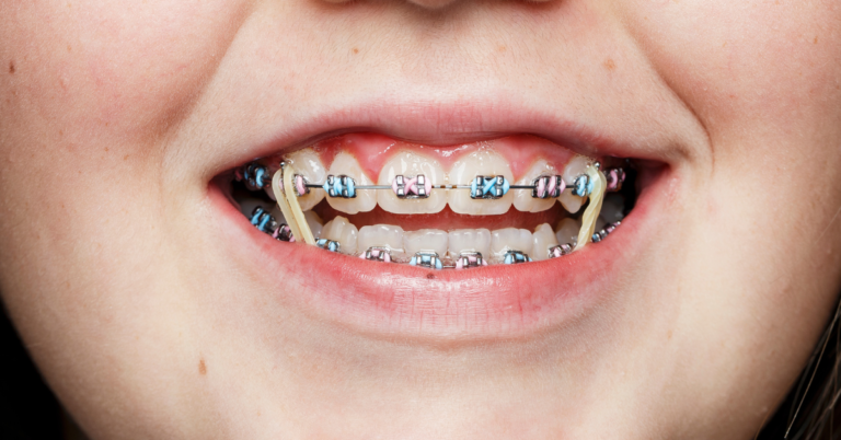 Understanding the Benefits of Using Rubber Bands with Braces