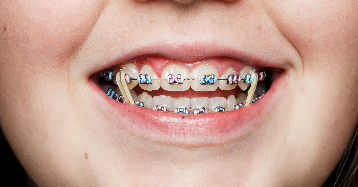 Understanding the Benefits of Using Rubber Bands with Braces